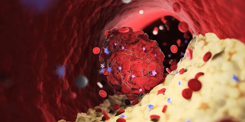 3D-Illustration eines Blutgerinnsels (Thrombus) in einer Arterie, umgeben von roten Blutkörperchen und Plaqueablagerungen, das den Blutfluss blockiert.